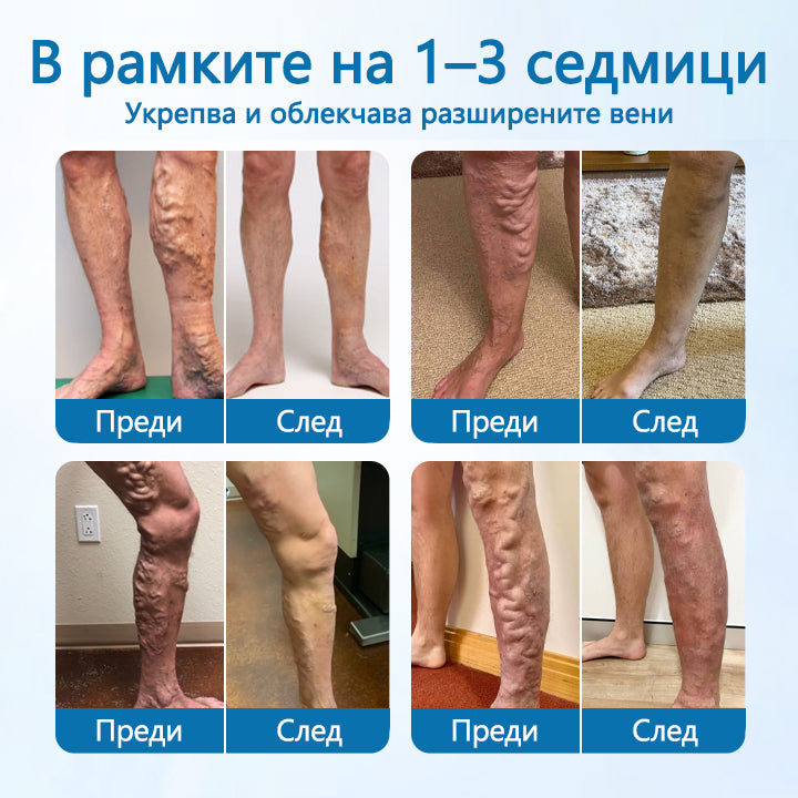 Timilk® VeinGuard Herbal Spray-✅ Клинично доказано е, че премахва разширените вени само за 7 дни!