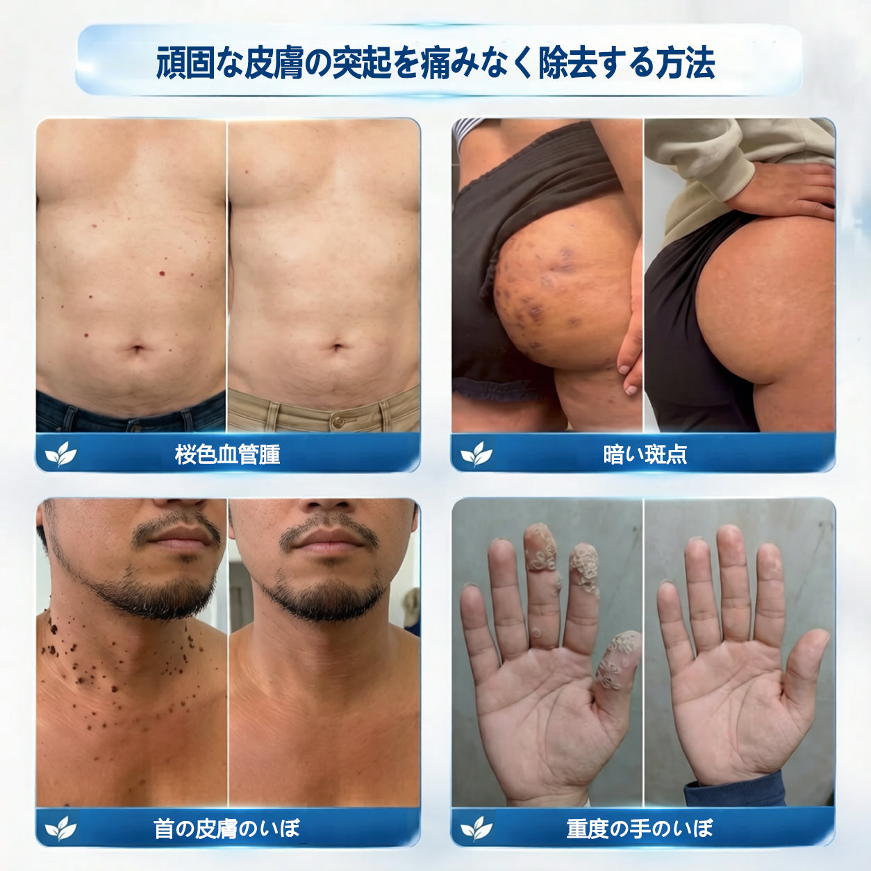 公式ストア🔥7 日間ピンポイントケアローラー 痛みなし・傷跡残らないタイプ