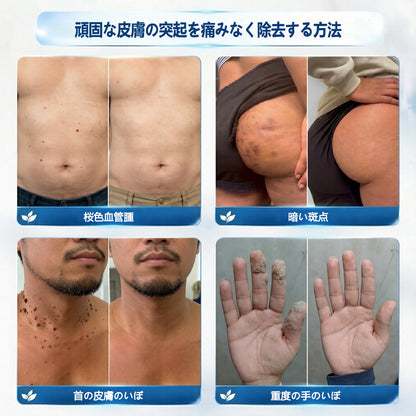公式ストア🔥7 日間ピンポイントケアローラー 痛みなし・傷跡残らないタイプ